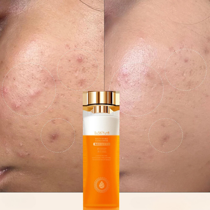 Bottiglia di siero per il viso con effetto anti-acne, prima e dopo l'uso su pelle con cicatrici da acne. Trattamento skincare efficace.