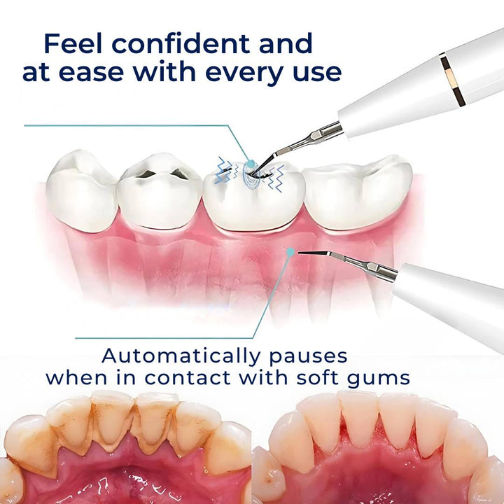 Plaquefree Plaque Remover per denti | Denti ad ultrasuoni Cleaner - Tartar Remover da casa - pulizia dei denti profondi e polacco 6